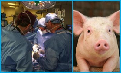 Pig Kidney Transplant